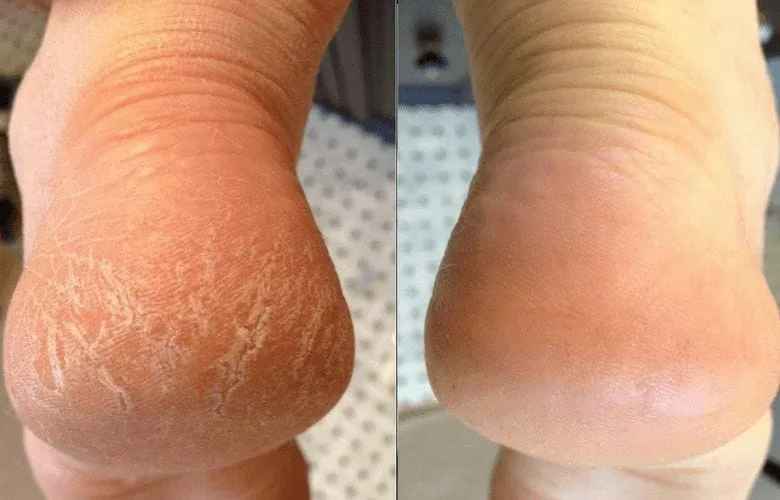This Pantry Staple Can Help Heal Cracked Heels—Here's How to Use It