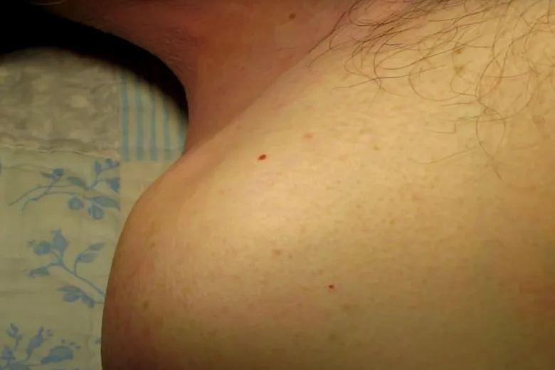 Dermatologists Explain How to Remove Those Red Spots on Your Skin