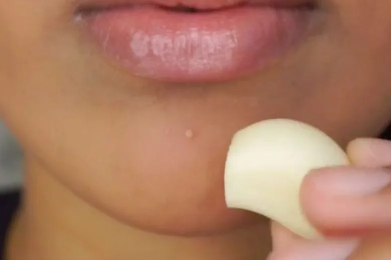 Surprising Remedy: Garlic as a Natural Acne Solution