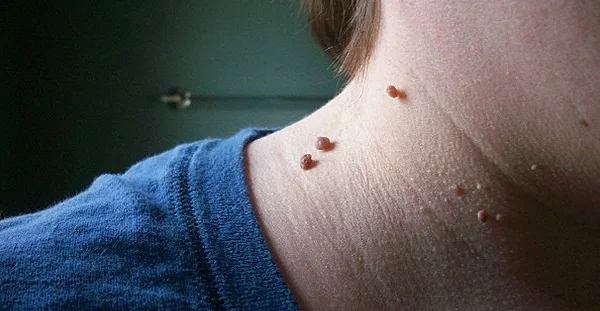 Discover a Simple and Painless Way to Remove Skin Tags!
