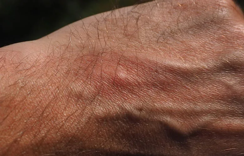 mosquito bite
