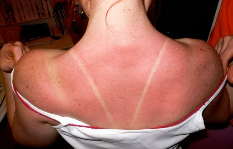 Why You Should Never Peel Sunburned Skin