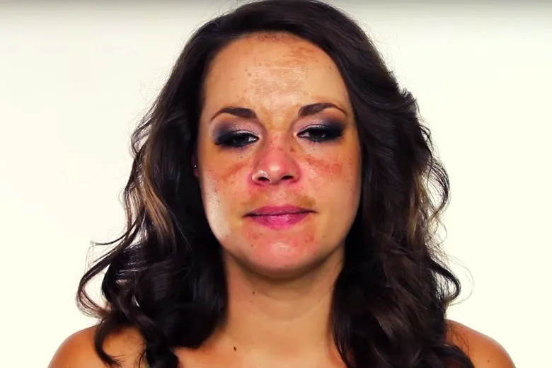 Pigment Mustache: How to Prevent and Remove Discoloration Above the Lip