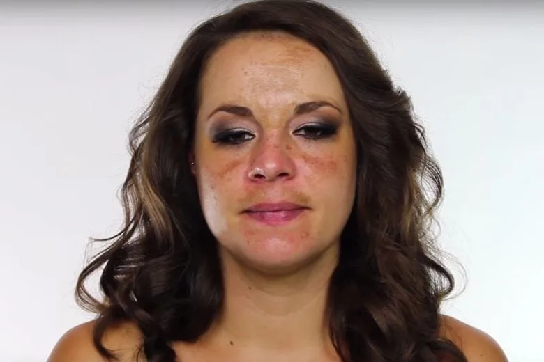 Understanding Skin Pigmentation: Causes and Solutions