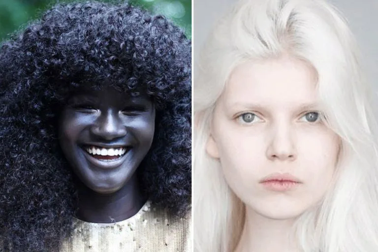 20 People With Remarkable Genetic Traits You Won't Forget