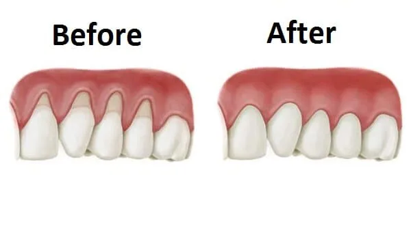 Struggling with Receding Gums? This Natural Remedy Could Be Your Answer