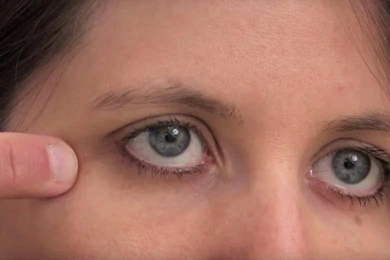 A Simple Trick to Remove Milia at Home