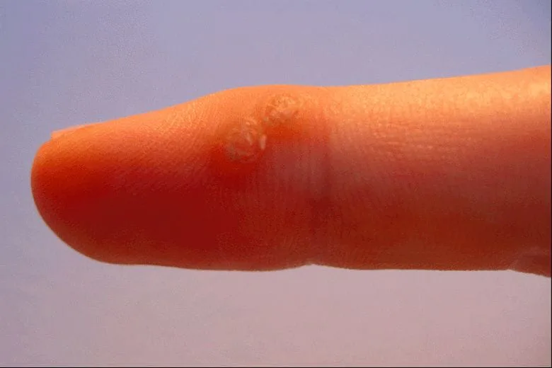 A Painless Way to Remove a Small Wart at Home