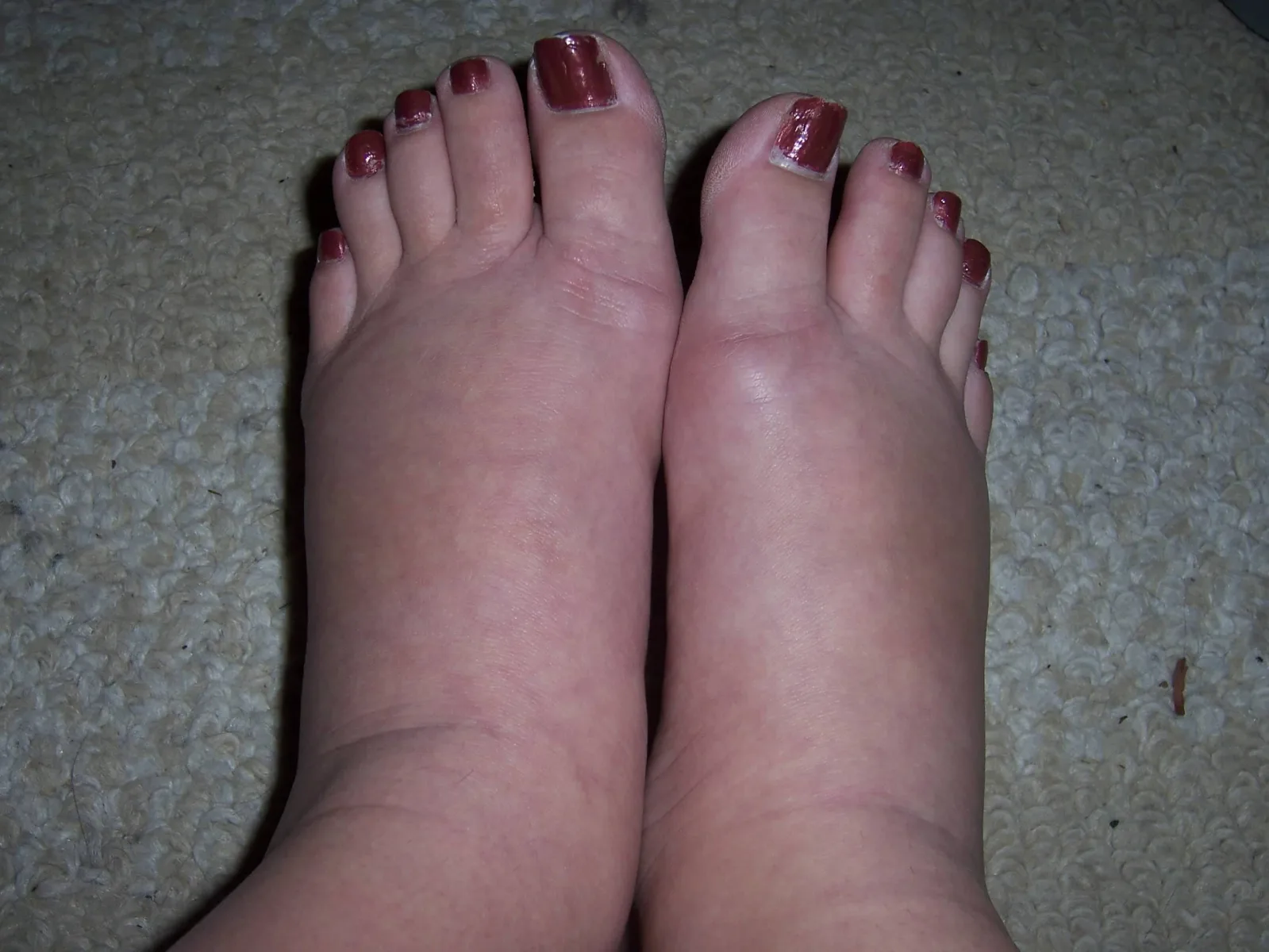 She Had Severely Swollen Feet—But These 6 Simple Tips Made All the Difference!