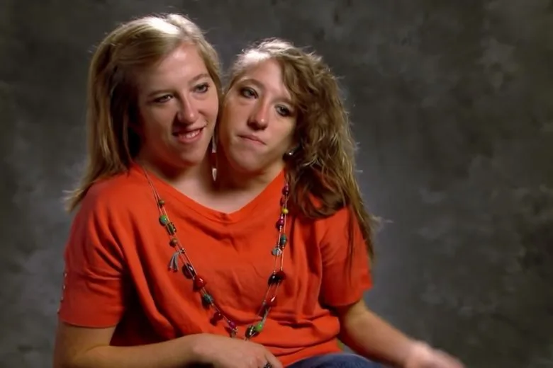 Years After Their Birth, These Conjoined Twins Revealed a Jaw-Dropping Secret
