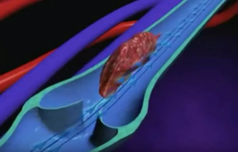 9 Warning Signs Your Body May Be Sending About a Blood Clot