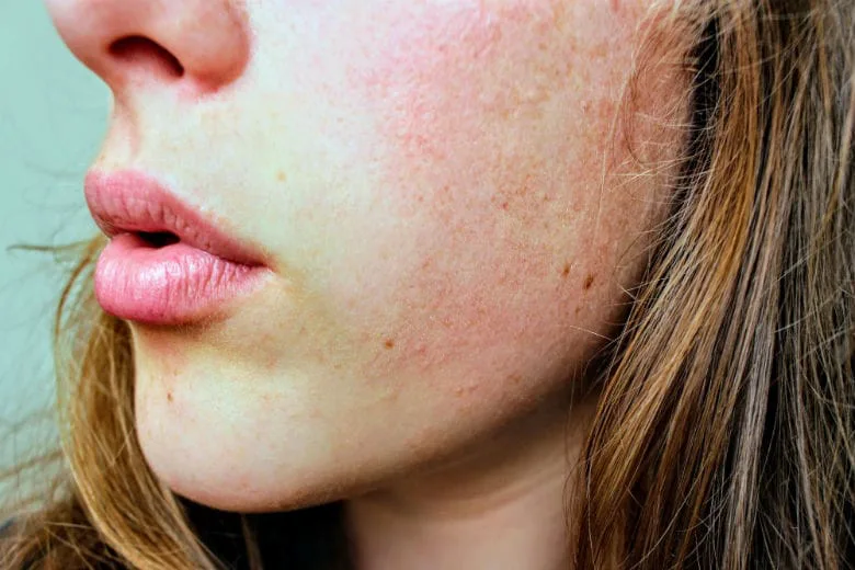 Struggling with Acne or Other Skin Issues? Try This Drink!