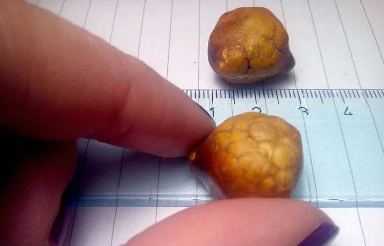 7 Types of Stones That Can Form Inside Your Body