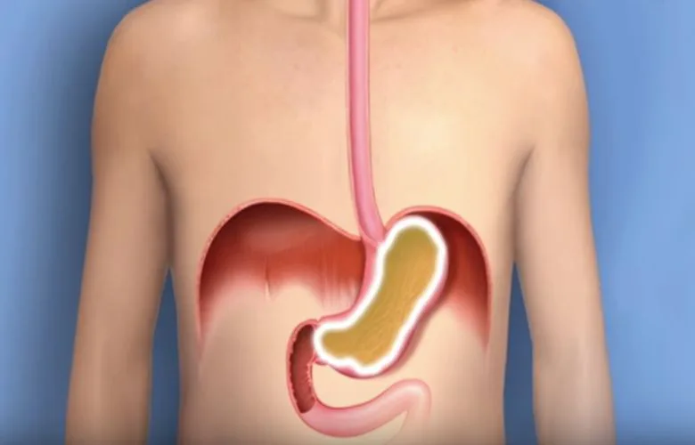 Struggling with Heartburn? These Simple Tips Will Help You Find Relief Quickly