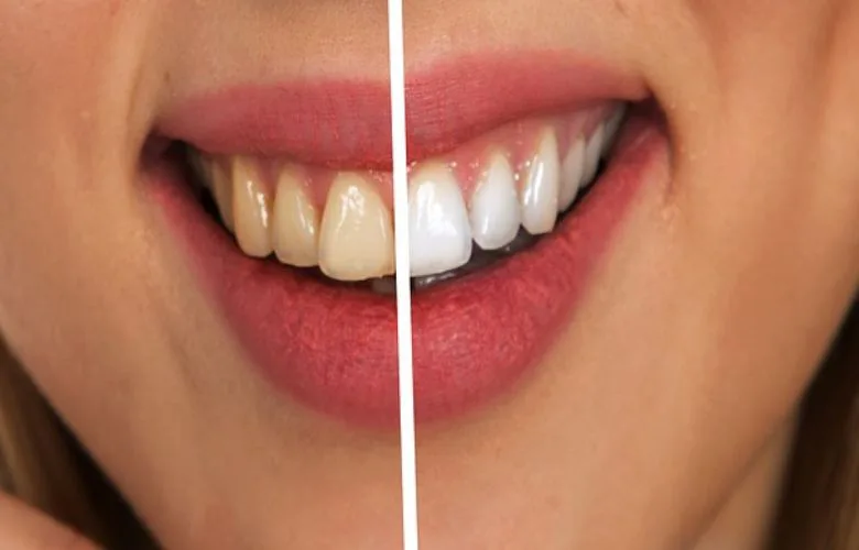Surprising Habits That Can Yellow Your Teeth