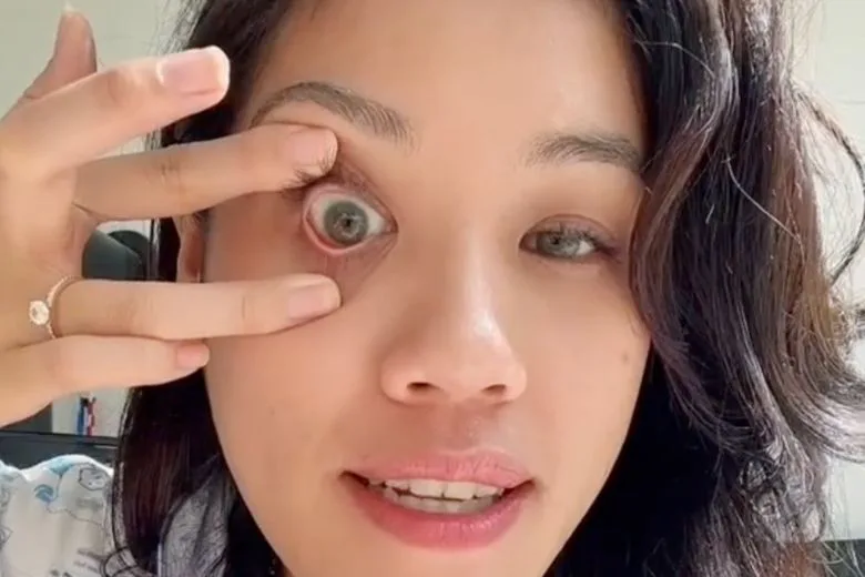 A Popular TikTok Creator Shares a Genius Trick to Remove Contact Lenses in Seconds